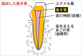 知覚過敏の原因と対策方法