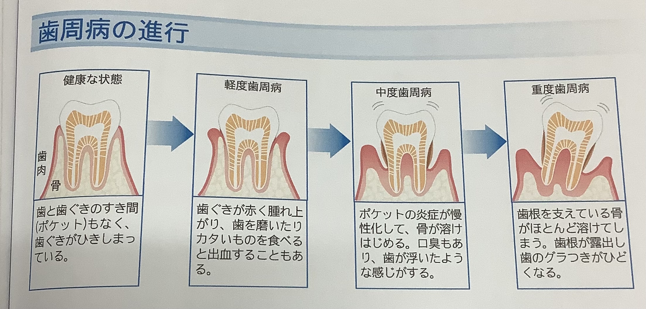 歯周病ってどんな病気？