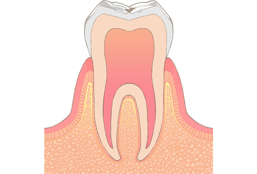 初期虫歯/エナメル質の虫歯
