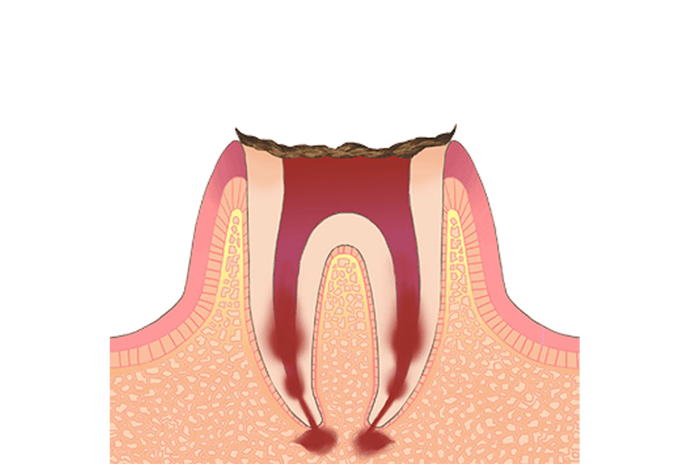 歯根だけが残っている歯の虫歯