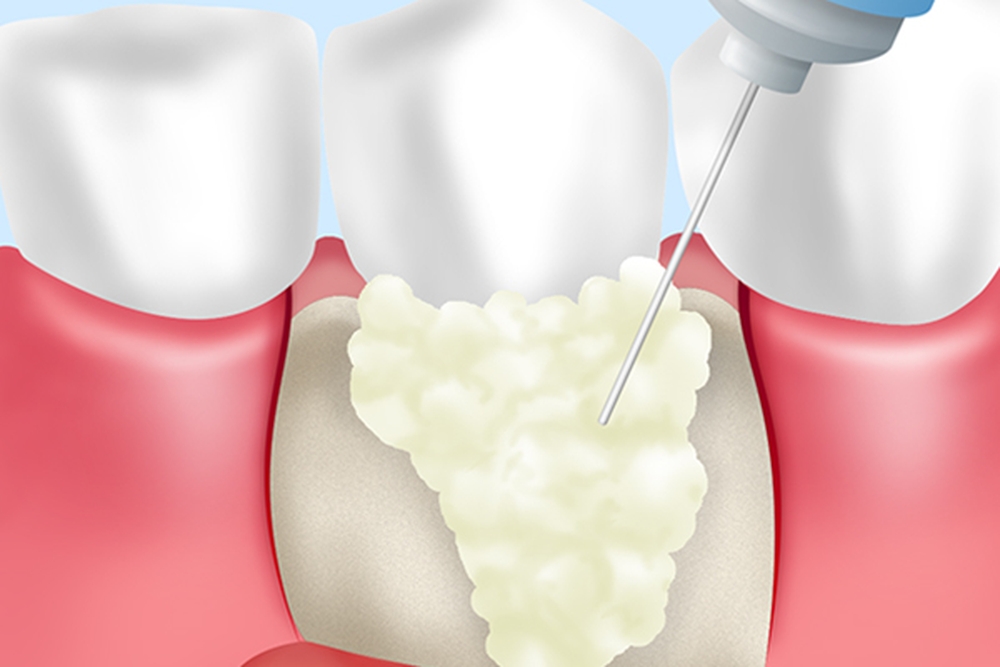 歯周組織再生療法