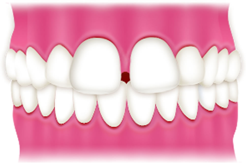 空隙歯列（すきっ歯）