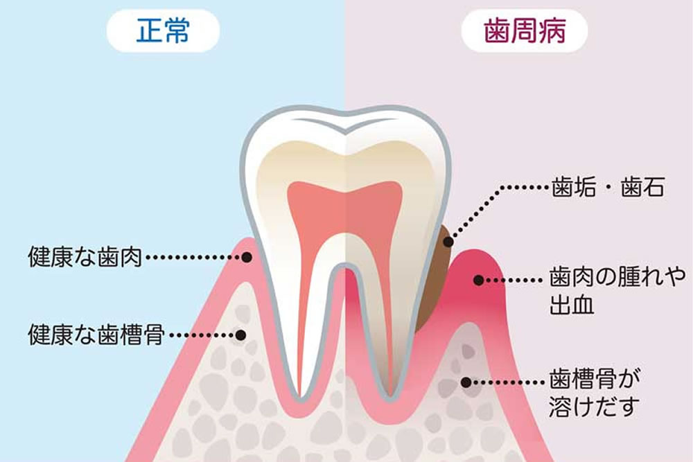 歯周病の原因・症状について